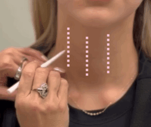 platysma botox
